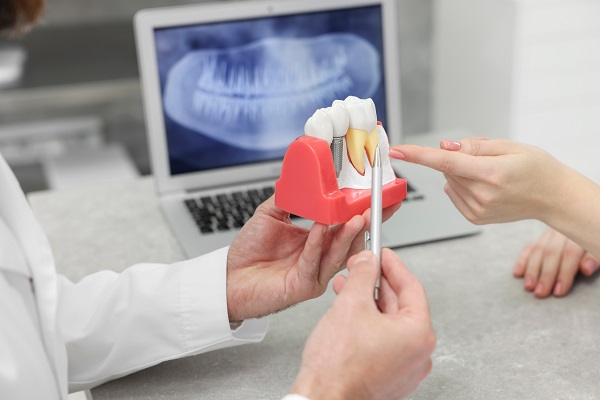 Why Dental Implants Are Comfortable And Secure